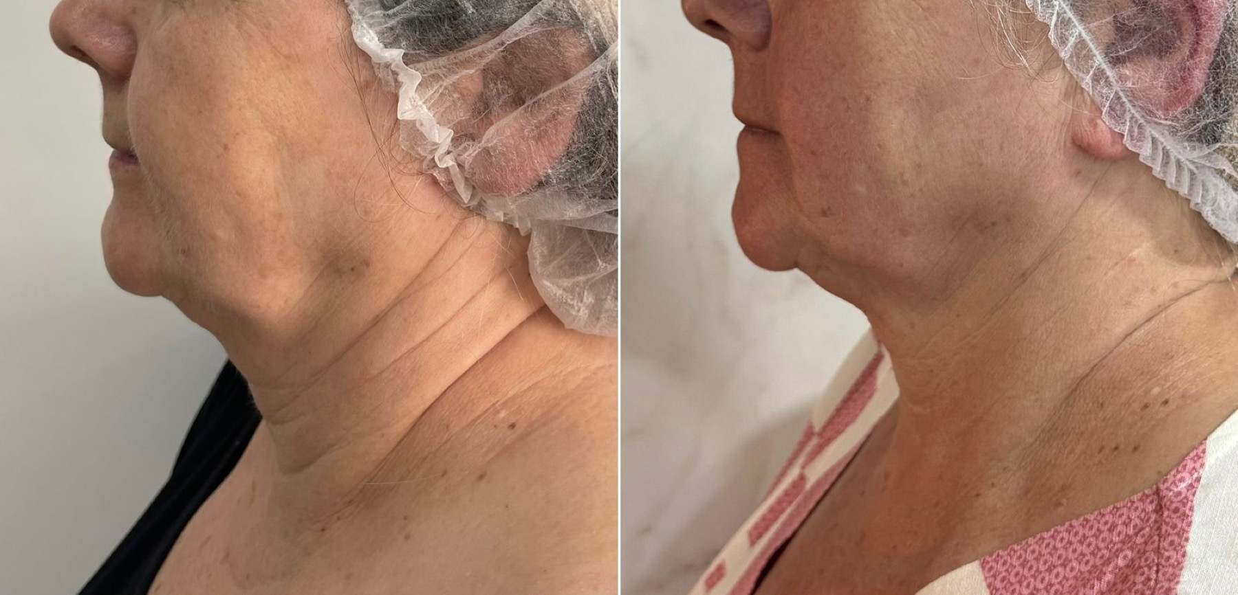 Antes e depois de tratamento na região do pescoço