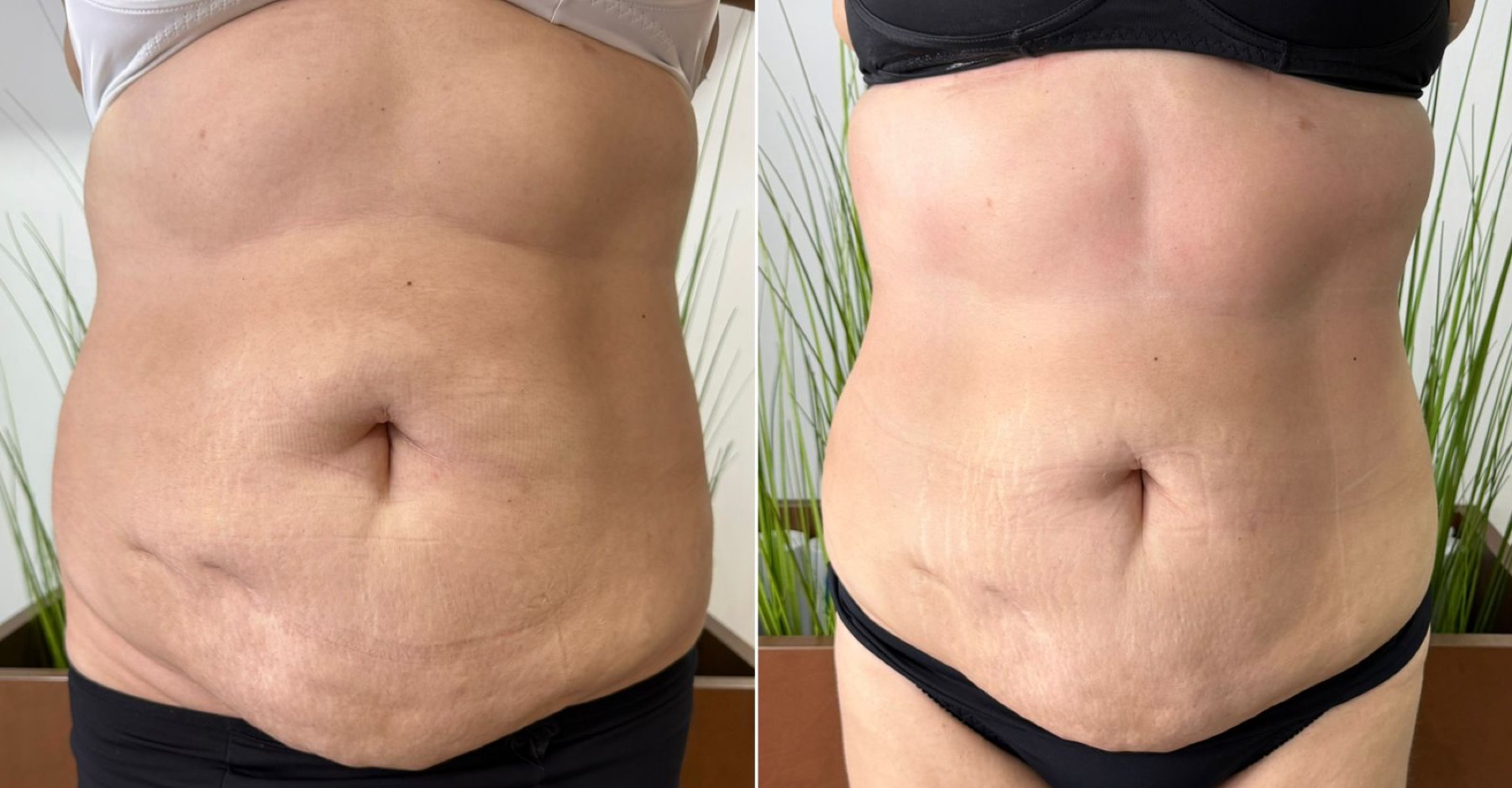 Antes e depois de tratamento corporal abdominal