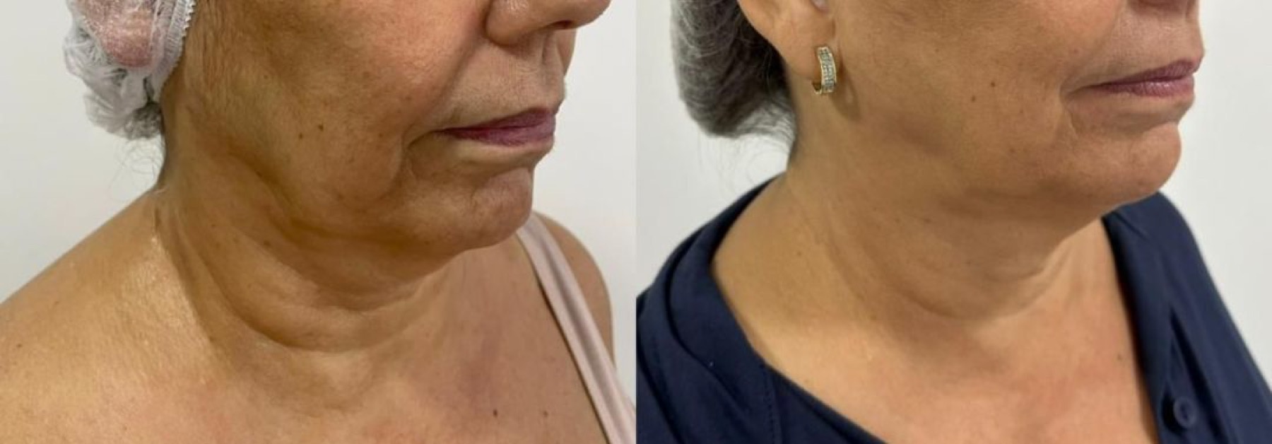 Antes e depois de tratamento facial