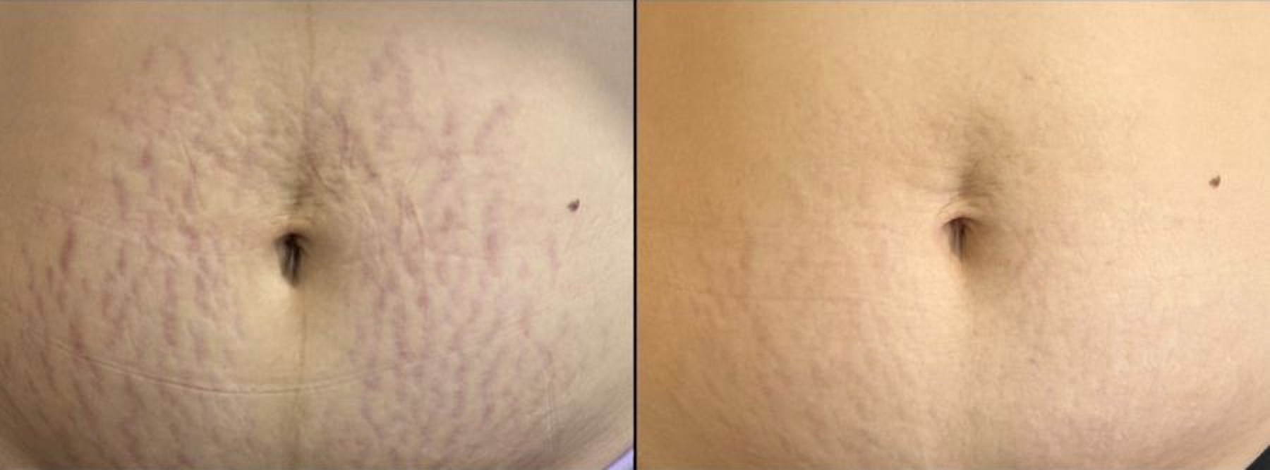 Antes e depois de tratamento para estrias