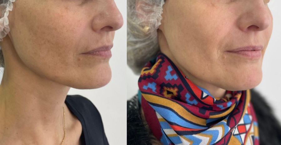 Antes e depois de tratamento facial na região do rosto e pescoço