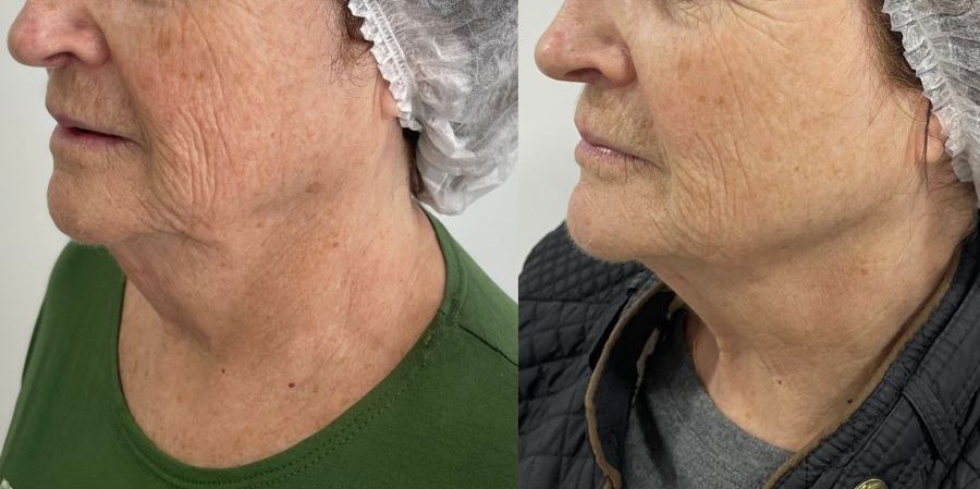 Antes e depois de tratamento facial para textura e firmeza