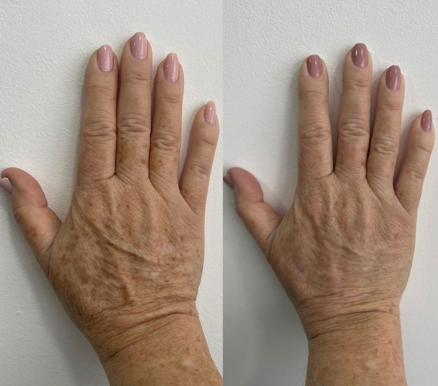 Antes e depois de tratamento para manchas nas mãos