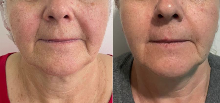 Antes e depois de tratamento facial com acompanhamento estético